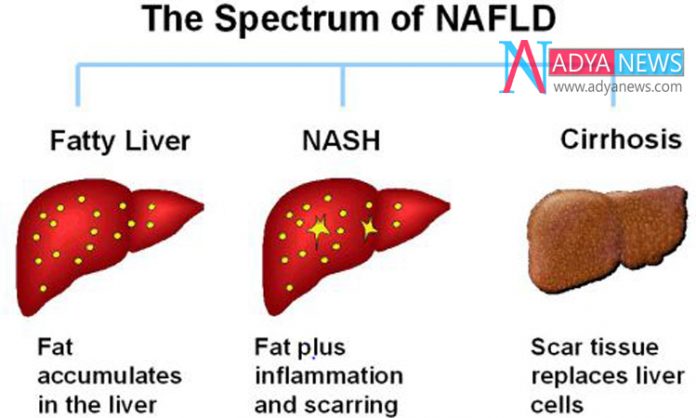 April-19-World-liver-day-To April 19 World liver day To Give The Awareness of Liver Disease